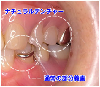 ナチュラルデンチャー（ノンクラスプデンチャー）