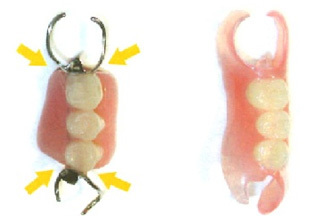 ナチュラルデンチャー（ノンクラスプデンチャー）